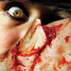 3D Tinsley Transfer Bone Tracture